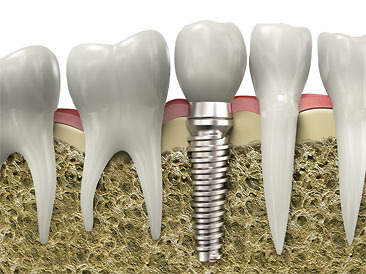 IMPLANT NHA KHOA