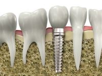 IMPLANT NHA KHOA